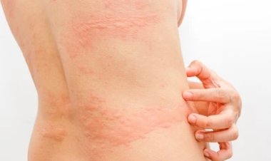 Urticária: O que é, causas, sintomas, diagnóstico e tratamento
